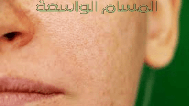 المسام الواسعة