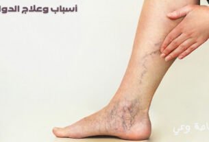 أسباب وطرق علاج الدوالي