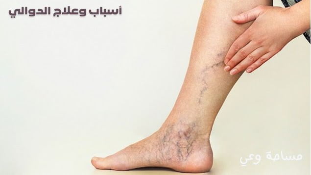 أسباب وطرق علاج الدوالي