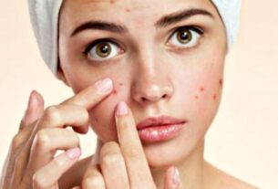 إزالة حب الشباب