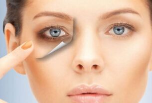 العلاج الأمثل للهالات السوداء