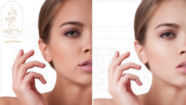 علاج المسامات الواسعة