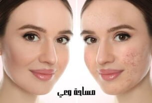 علاج ندبات حب الشباب