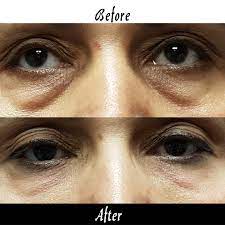 انتفاخ العين