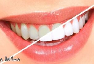 تبيض الأسنان في المنزل