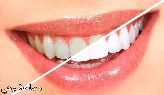 تبيض الأسنان في المنزل