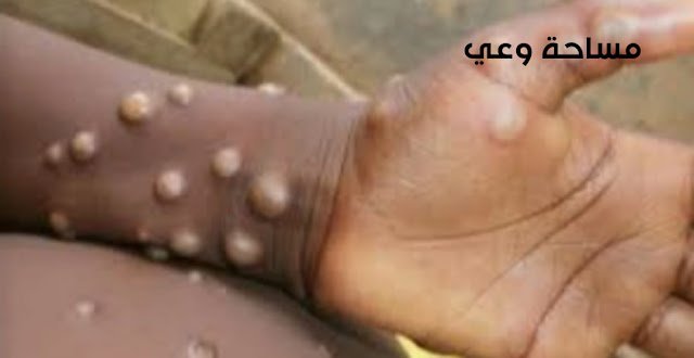 جدري القرود