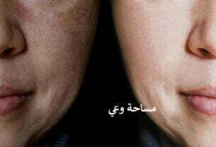 المسام الواسعة في الخدود