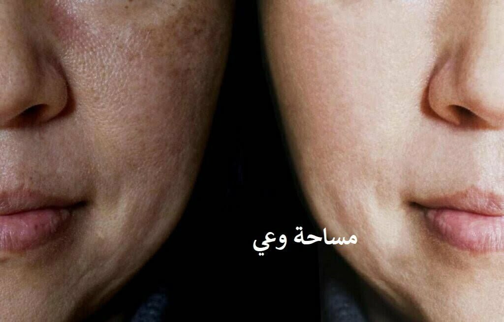 المسام الواسعة في الخدود