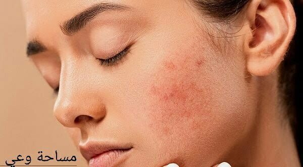 علاج الكلف القديم في المنزل