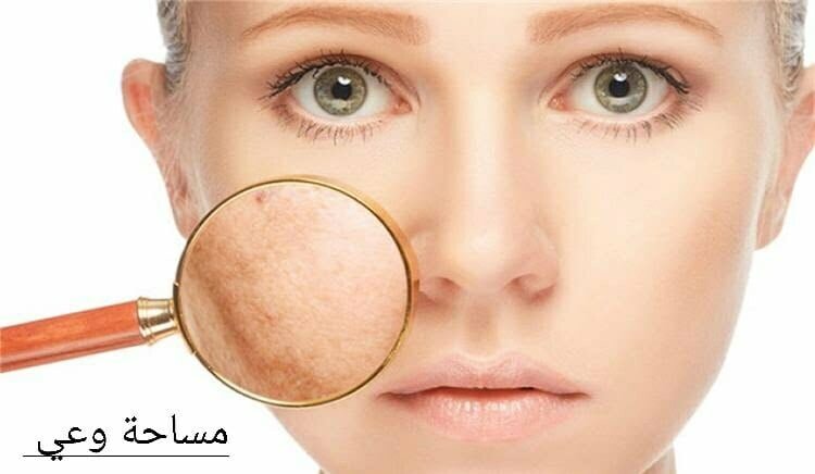 علاج الكلف القديم في المنزل علاج الكلف القديم