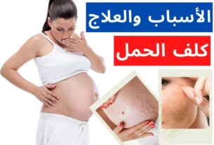 علاج كلف الحمل بعدة طرق طبيعية