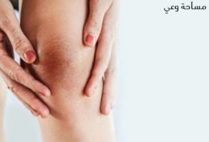 التخلص من سواد الركب