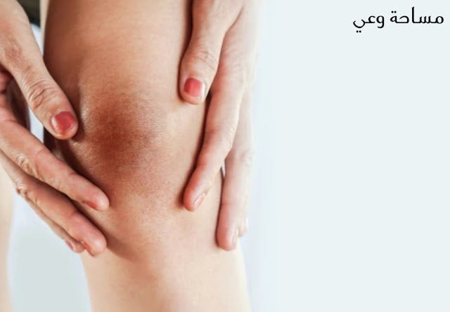 التخلص من سواد الركب