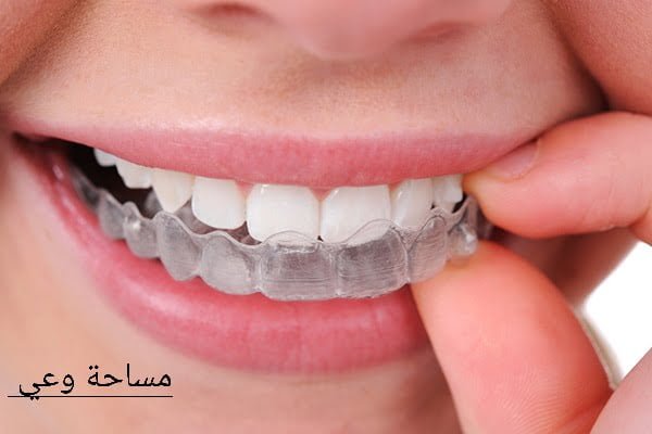 الفرق بين مثبت التقويم الشفاف والحديد الفرق بين مثبت التقويم الشفاف والحديد