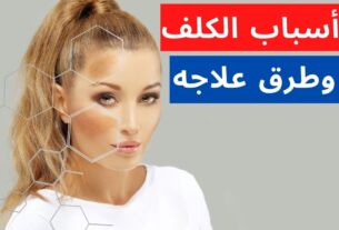 الكلف أسبابه وطرق علاجه