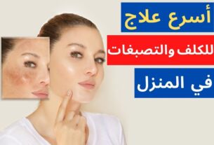 أسرع علاج للكلف بمكونات من منزلك