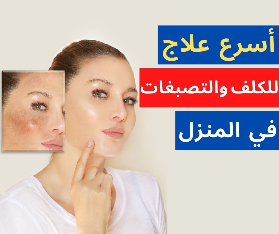 أسرع علاج للكلف بمكونات من منزلك