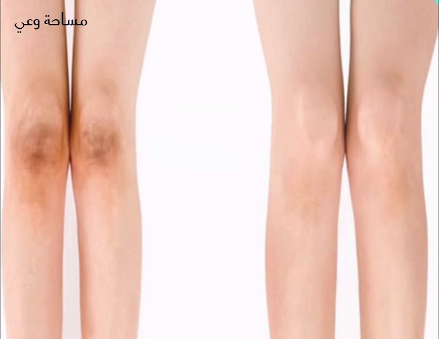 سبب اسمرار الركب