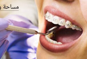شروط تركيب تقويم الأسنان
