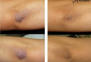 علاج سواد الركب بالليزر