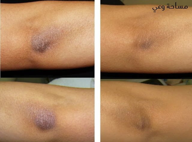 علاج سواد الركب بالليزر