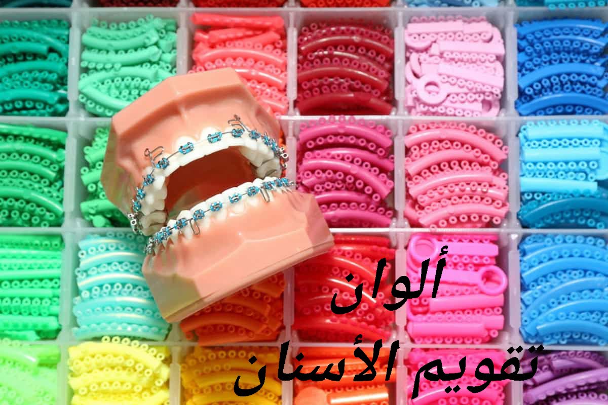 ألوان تقويم الأسنان