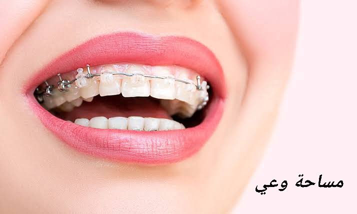مراحل تقويم الأسنان مراحل تقويم الأسنان