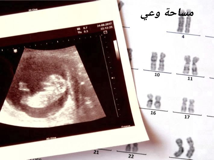 أسباب متلازمة داون أثناء الحمل