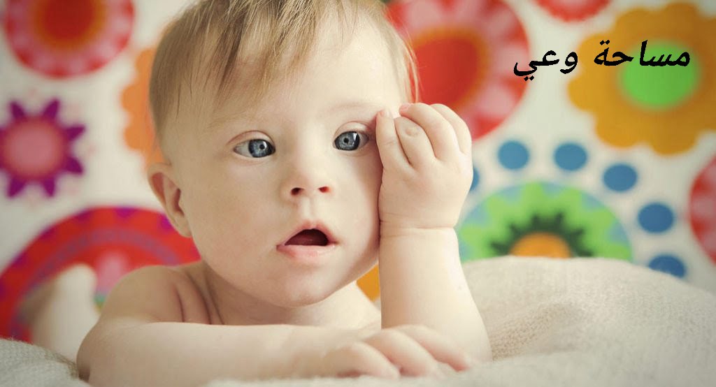 كم يعيش مريض متلازمة داون؟