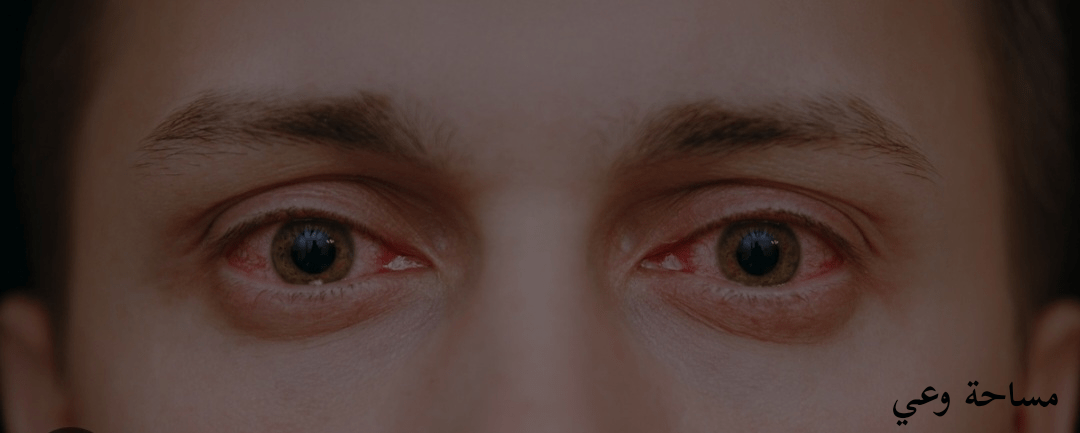 أعراض الرمد الربيعي