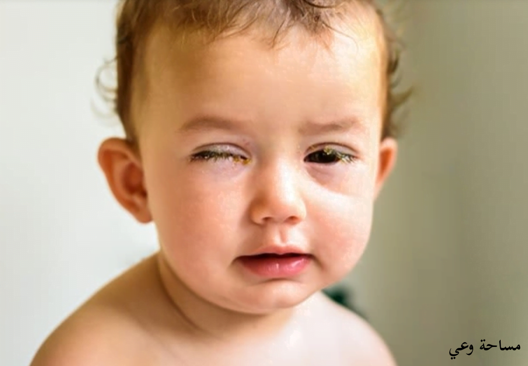 أعراض رمد العين عند حديثي الولاده