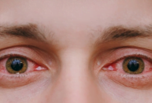 الرمد الربيعي