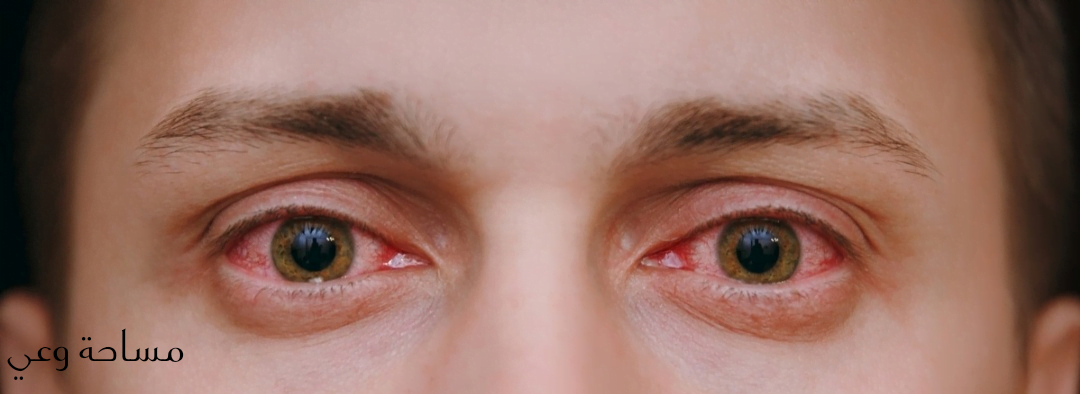 الرمد الربيعي