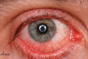 الفرق-بين-الرمد-الحبيبي-والرمد-الربيعي