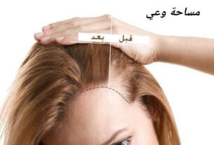 امبولات الخلايا الجذعية للشعر