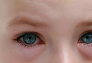 علاج الرمد للاطفال