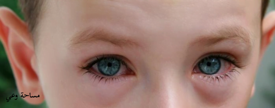 علاج الرمد للاطفال