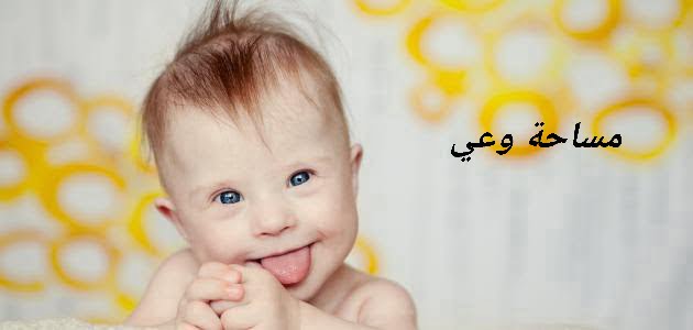 ما هي متلازمة داون ما هي متلازمة داون
