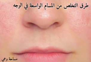 أفضل طرق علاج المسام الواسعة في الوجه