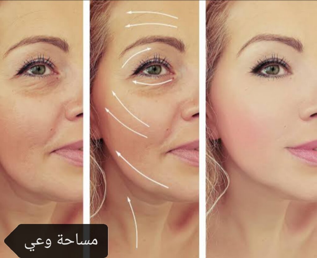 سعر إبرة البروفايلو