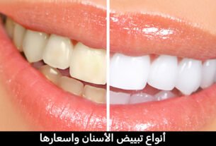 أنواع تبييض الأسنان واسعارها