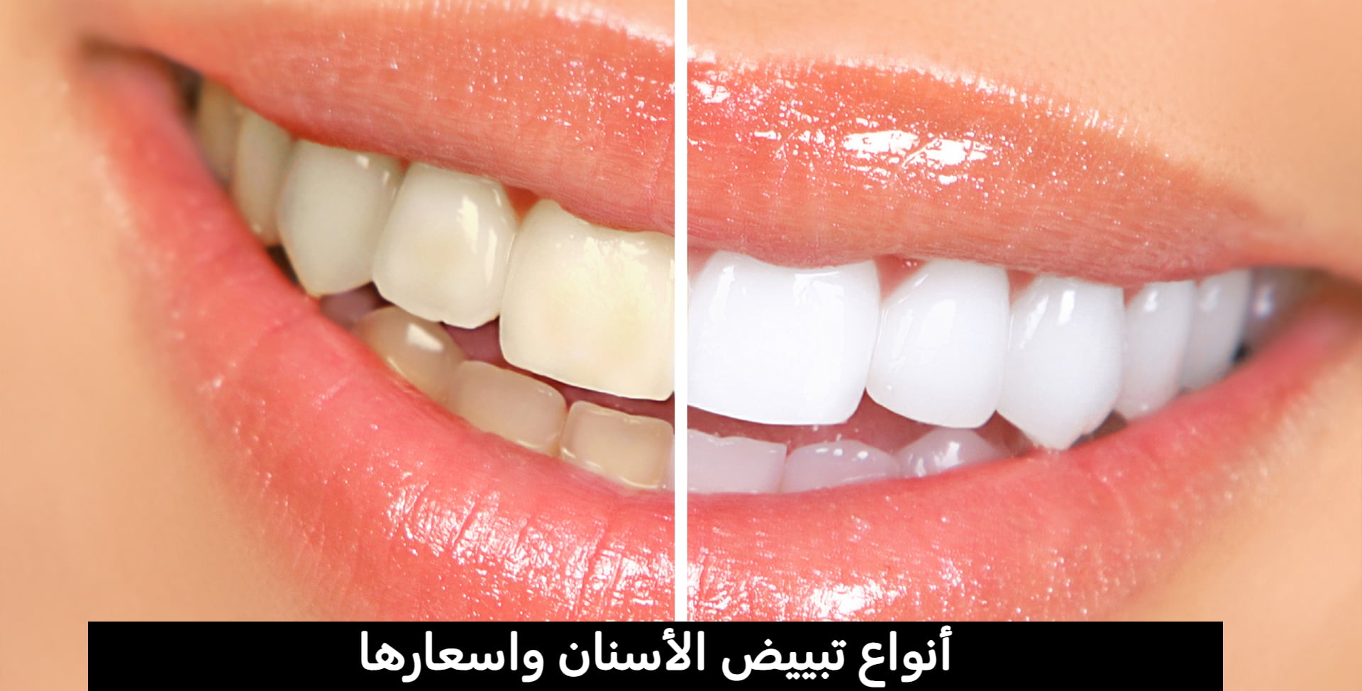 أنواع تبييض الأسنان واسعارها